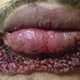 Resultado de la infección. Journal of Emergency Medicine
